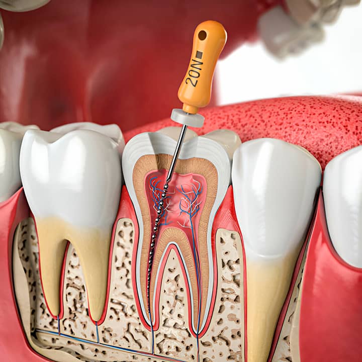 endodoncia